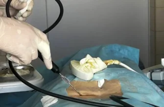 Криоабляция нервов медицина лечение постоянной боли