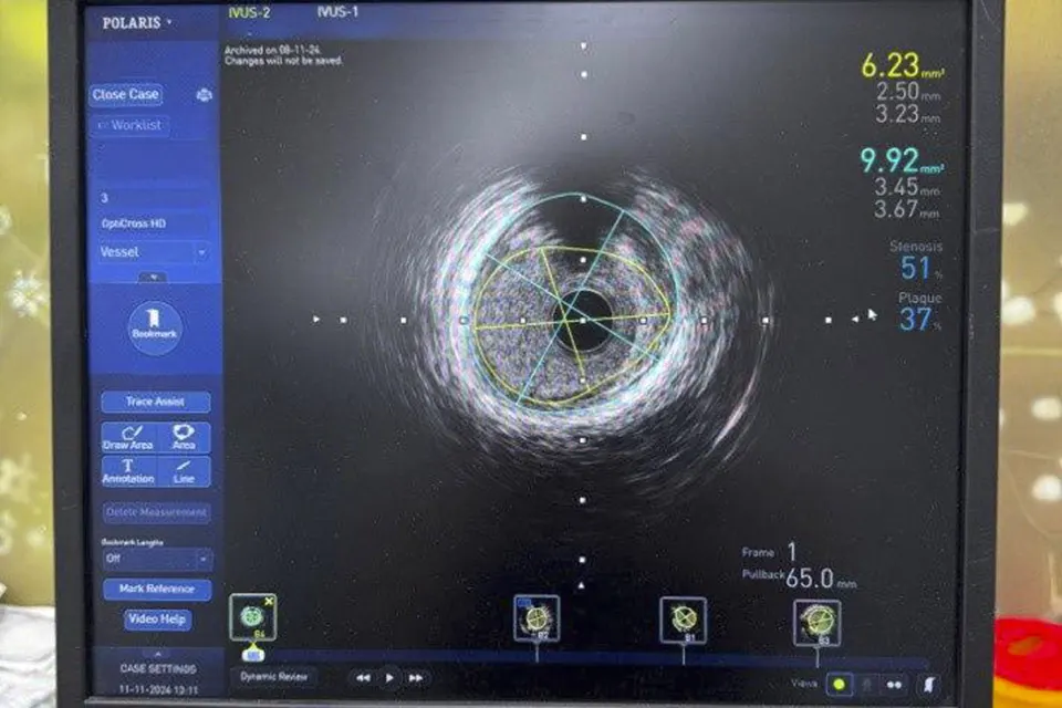 артерия изнутри