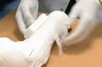 врач накладывает гипс на сломанную руку
